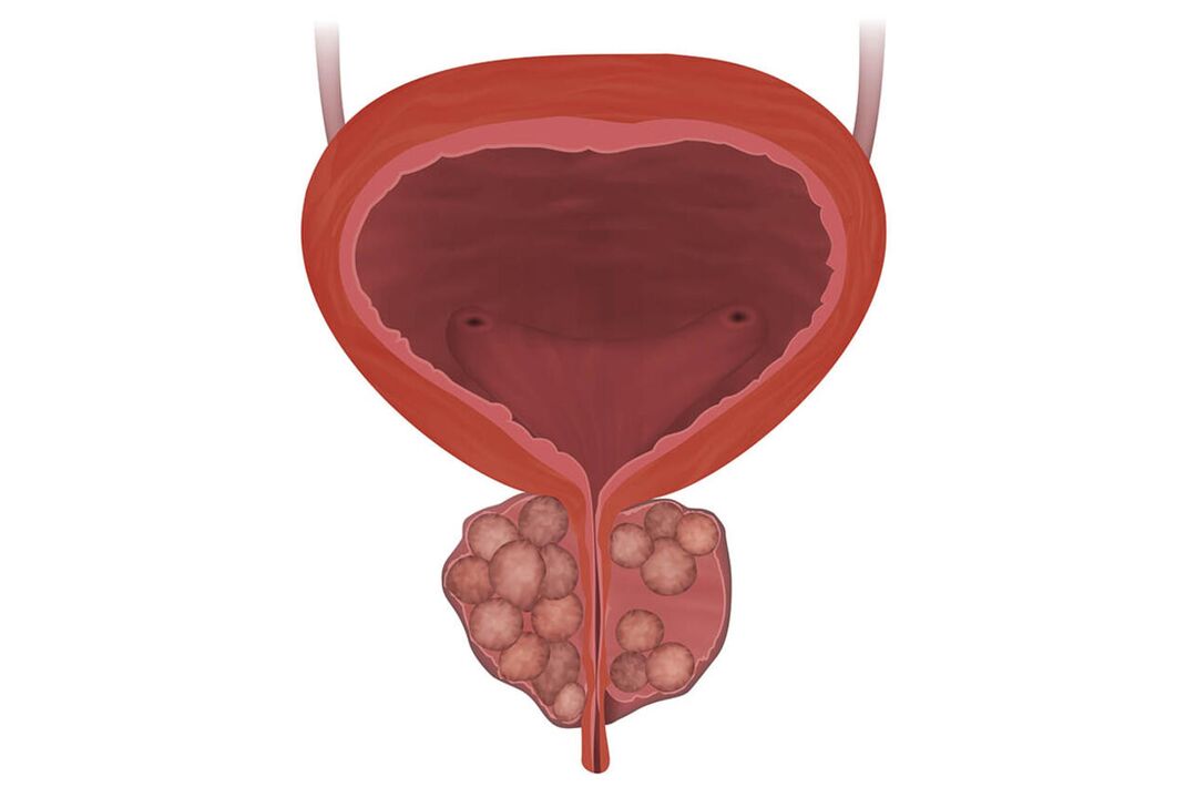 Simptomele prostatitei